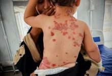 هشدار داکتر فلسطینی درباره گسترش بیماری‌های پوستی و عفونی در میان بی‌جاشدگان غزه