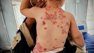 هشدار داکتر فلسطینی درباره گسترش بیماری‌های پوستی و عفونی در میان بی‌جاشدگان غزه