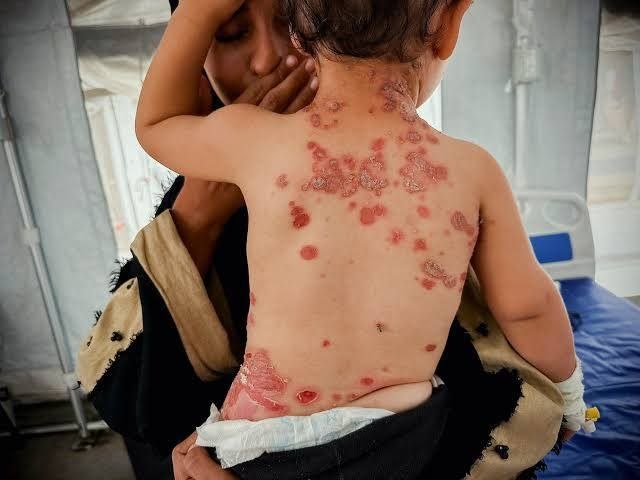 هشدار داکتر فلسطینی درباره گسترش بیماری‌های پوستی و عفونی در میان بی‌جاشدگان غزه